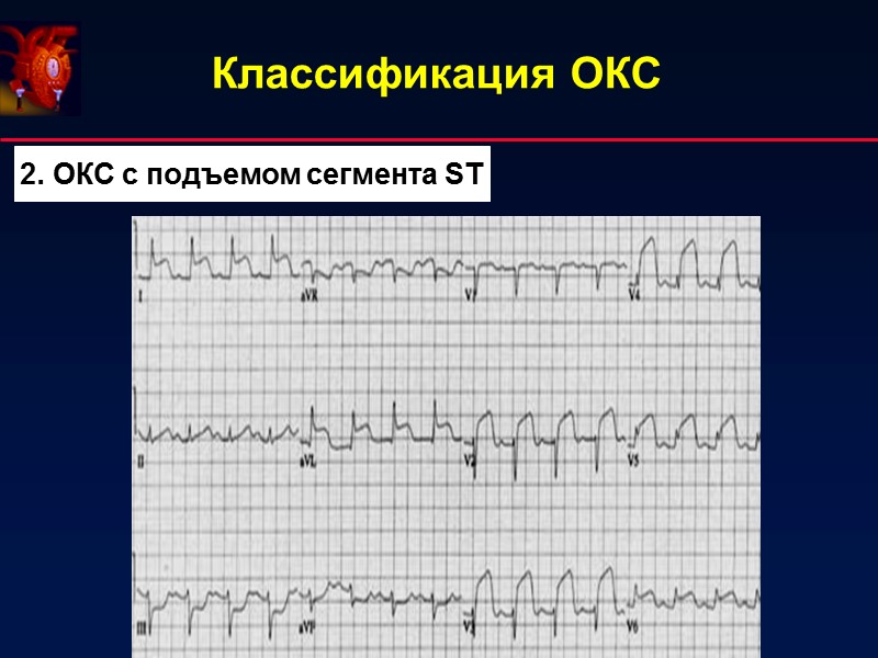Классификация ОКС 2. ОКС с подъемом сегмента ST Классификация ОКС 2. ОКС с подъемом сегмента ST